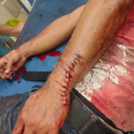 Melerai Perkelahian, PNS Ini Malah Dibacok